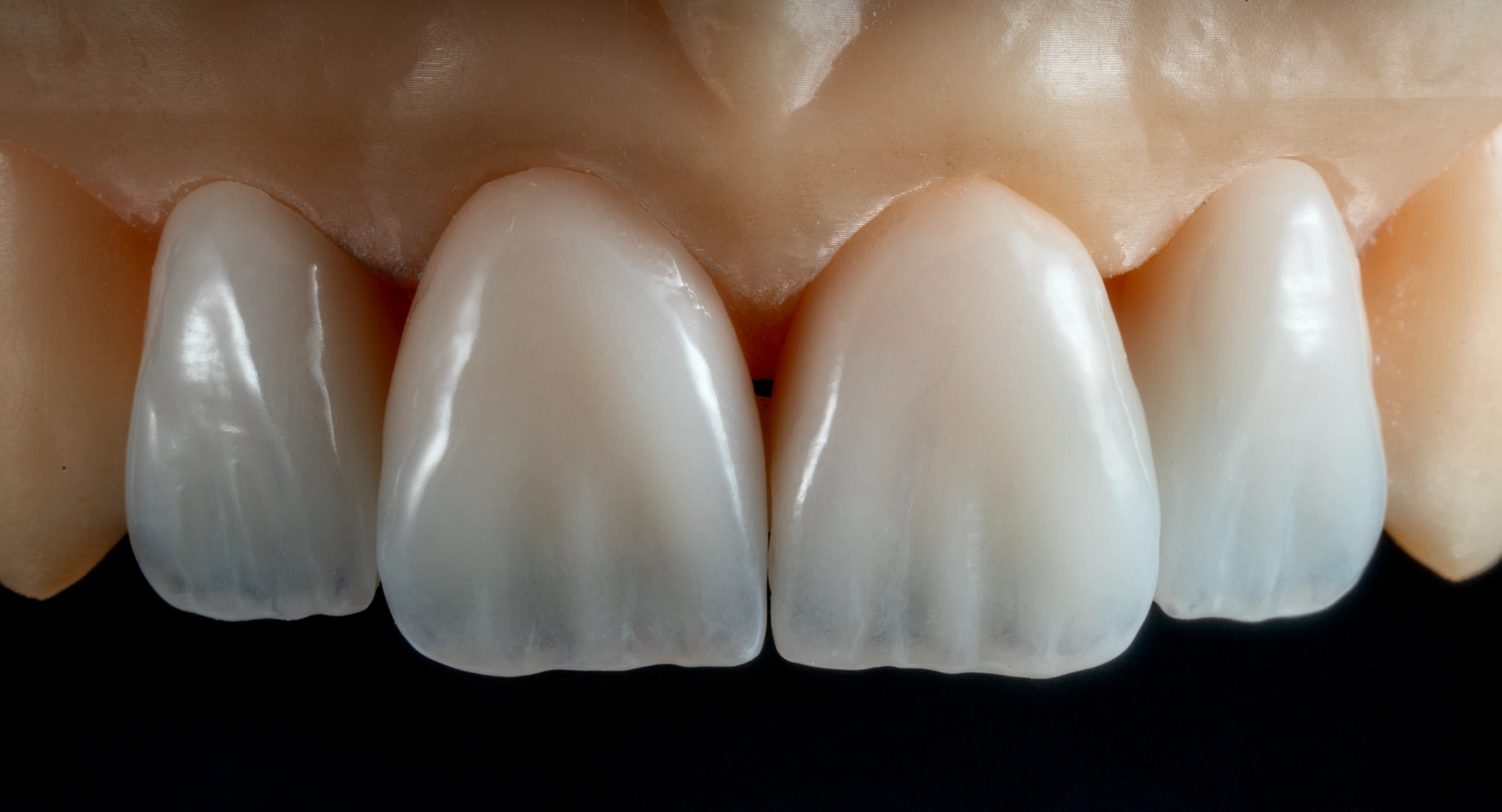Dettaglio di faccette su modello: forma, tessitura e traslucenza