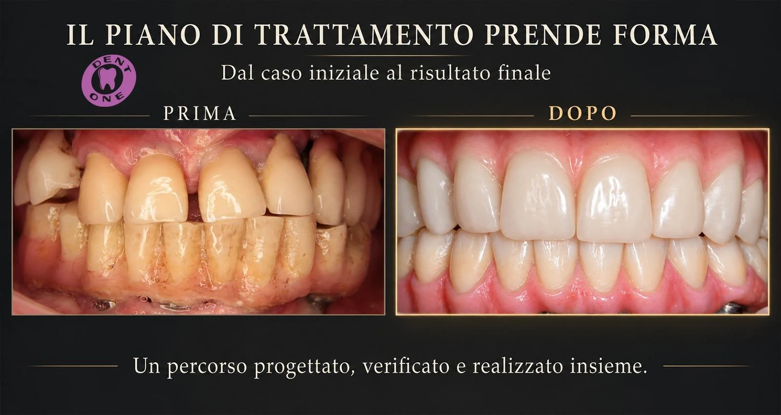Caso Barre DentOne - foto 1